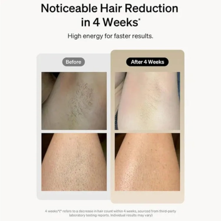 IPL Laser Hair Removal Device 900,000 Flashes for Body, Face & Bikini